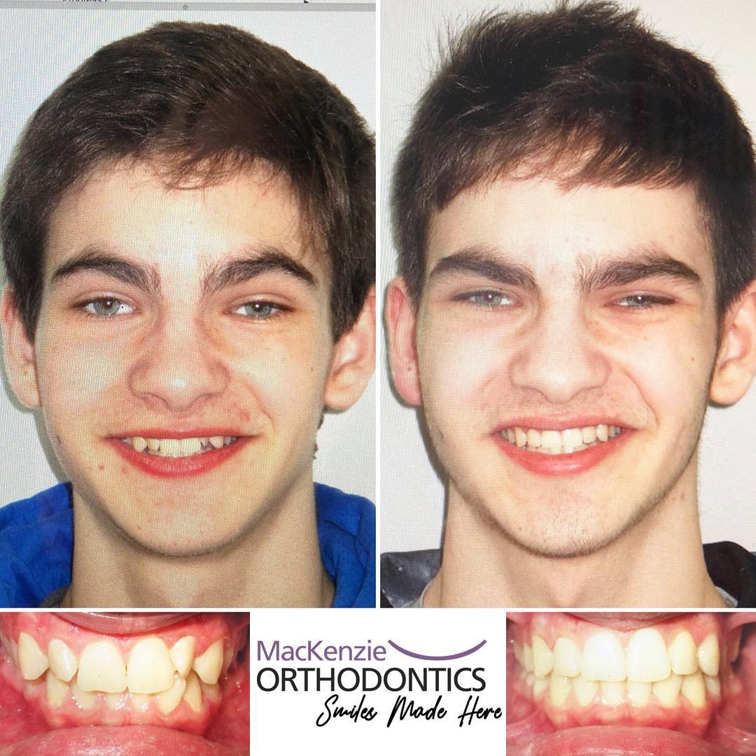 Invisalign for 13 months