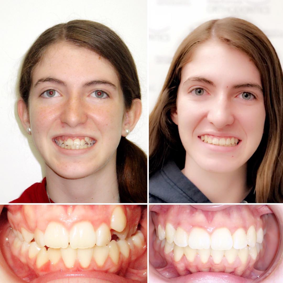 Invisalign for 12 months
