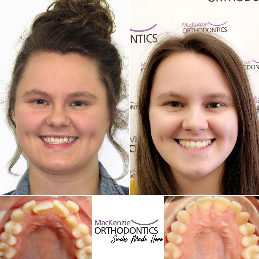Invisalign for 11 months