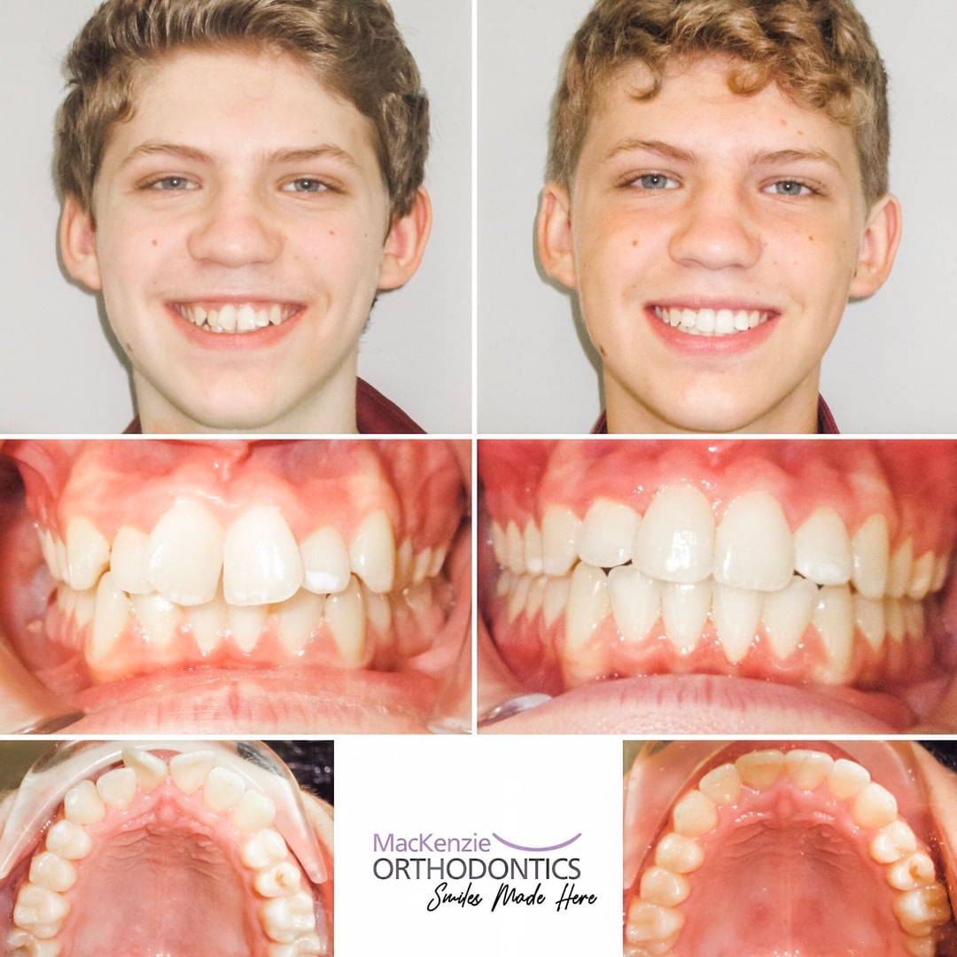 Invisalign for 12 months