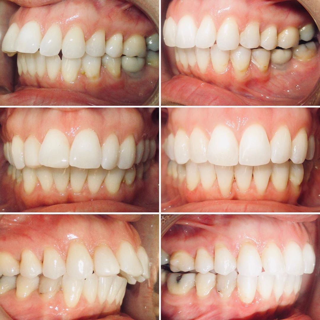 Invisalign for 13 months