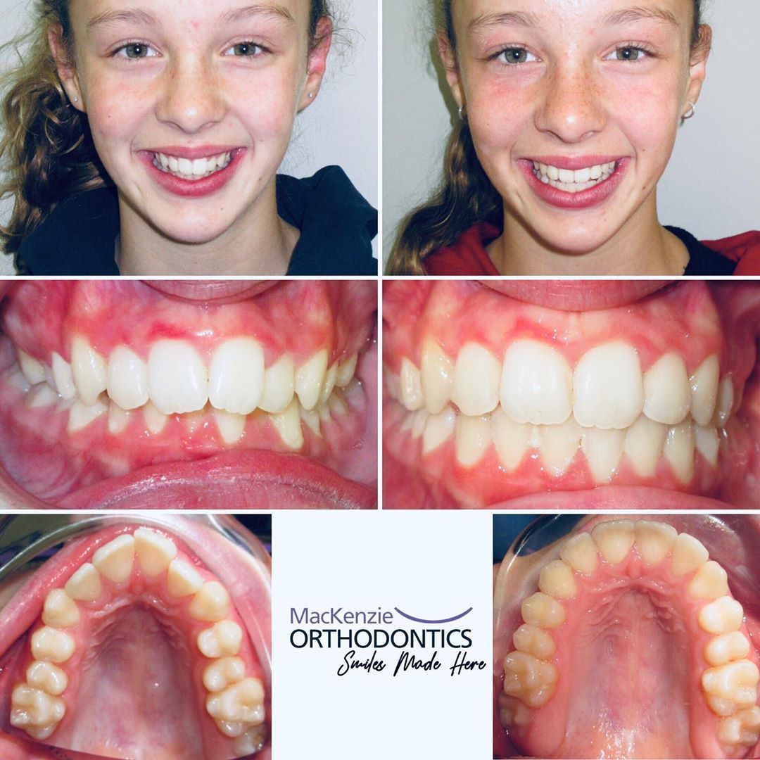 Invisalign for 8 months
