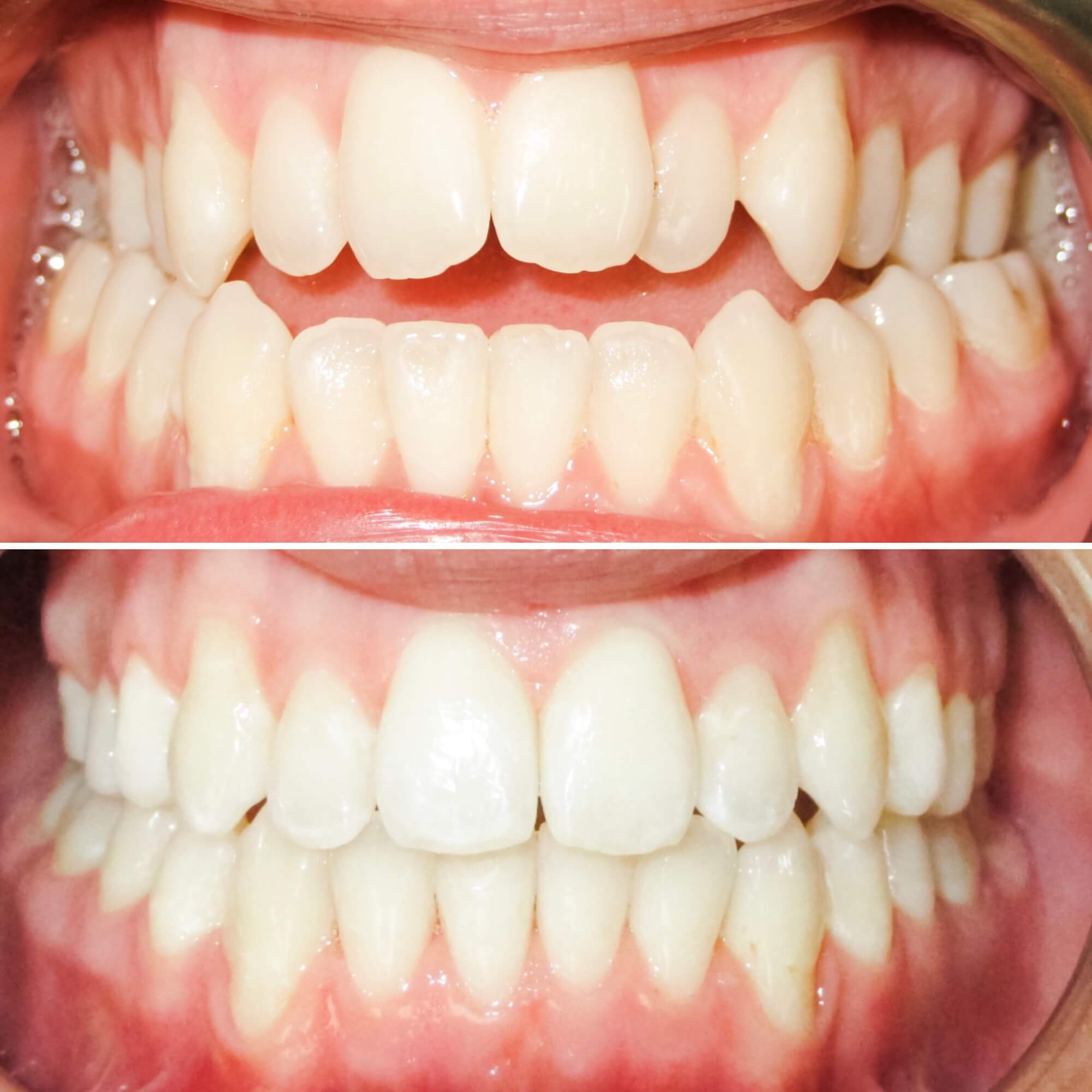 Open bite treated by Dr. MacKenzie, an orthodontist in Saint John