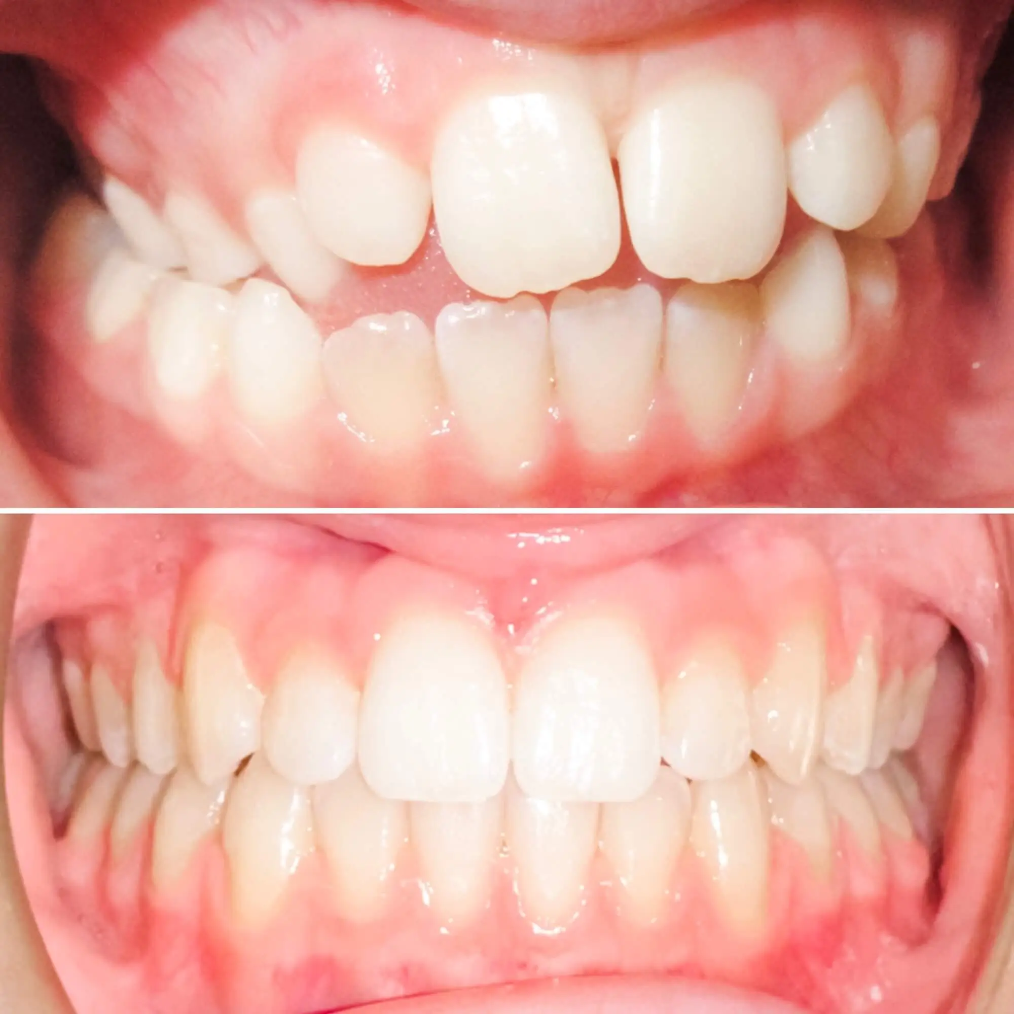 Posterior crossbite treated by MacKenzie Orthodontics in Saint John