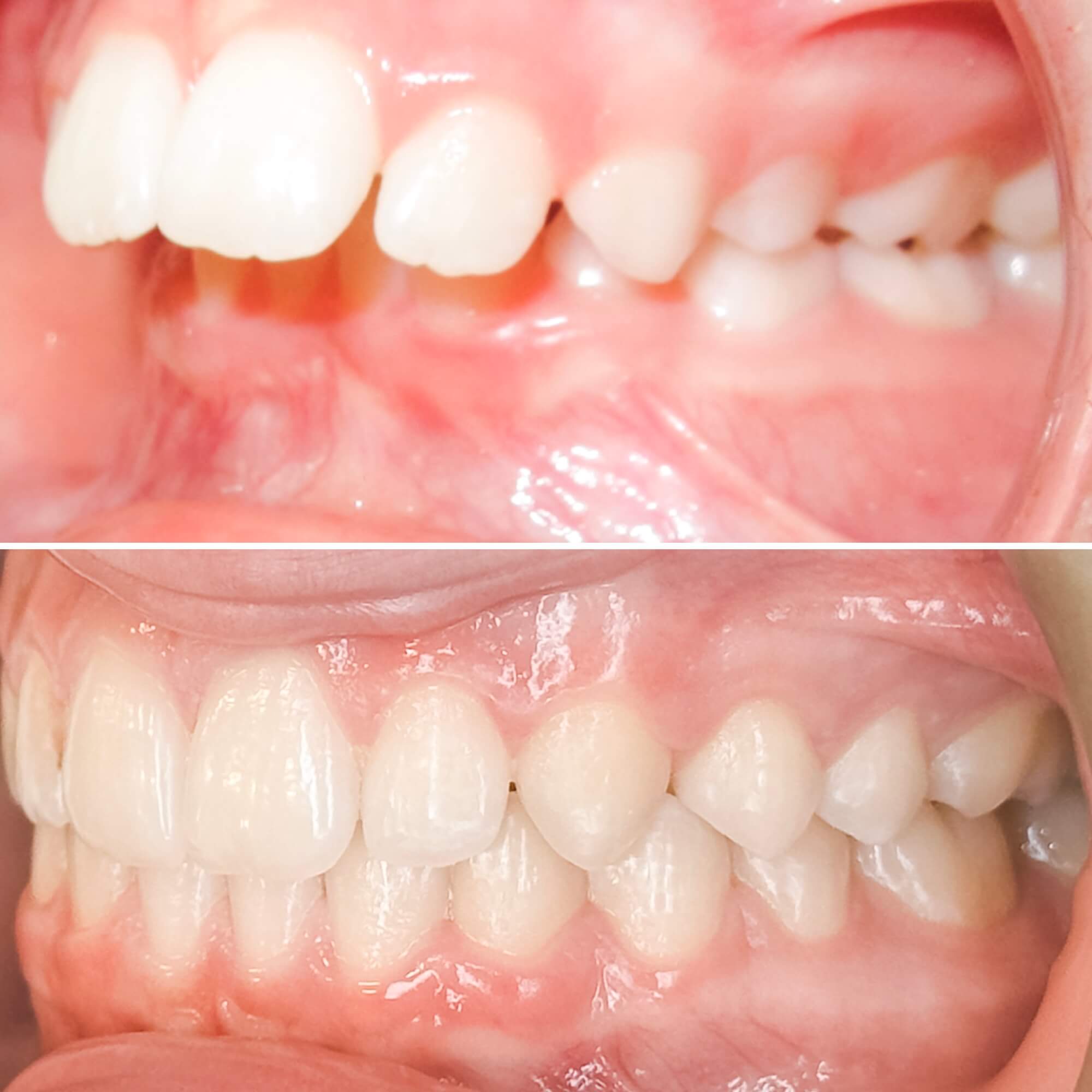 Excess overjet or overbite treated by MacKenzie Orthodontics