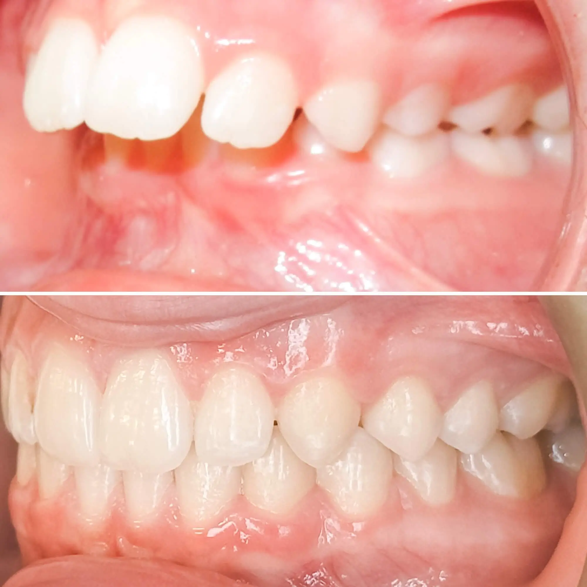 Excess overjet or overbite treated by MacKenzie Orthodontics