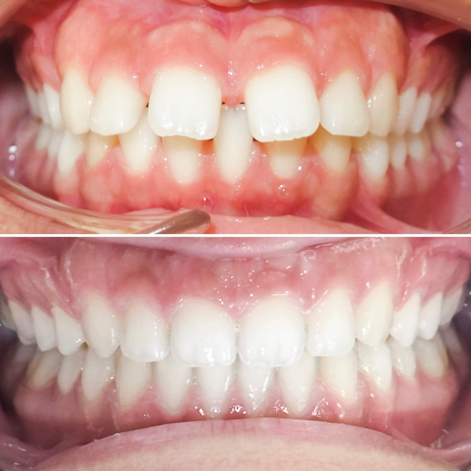 Teeth spacing treated by MacKenzie Orthodontics in Saint John