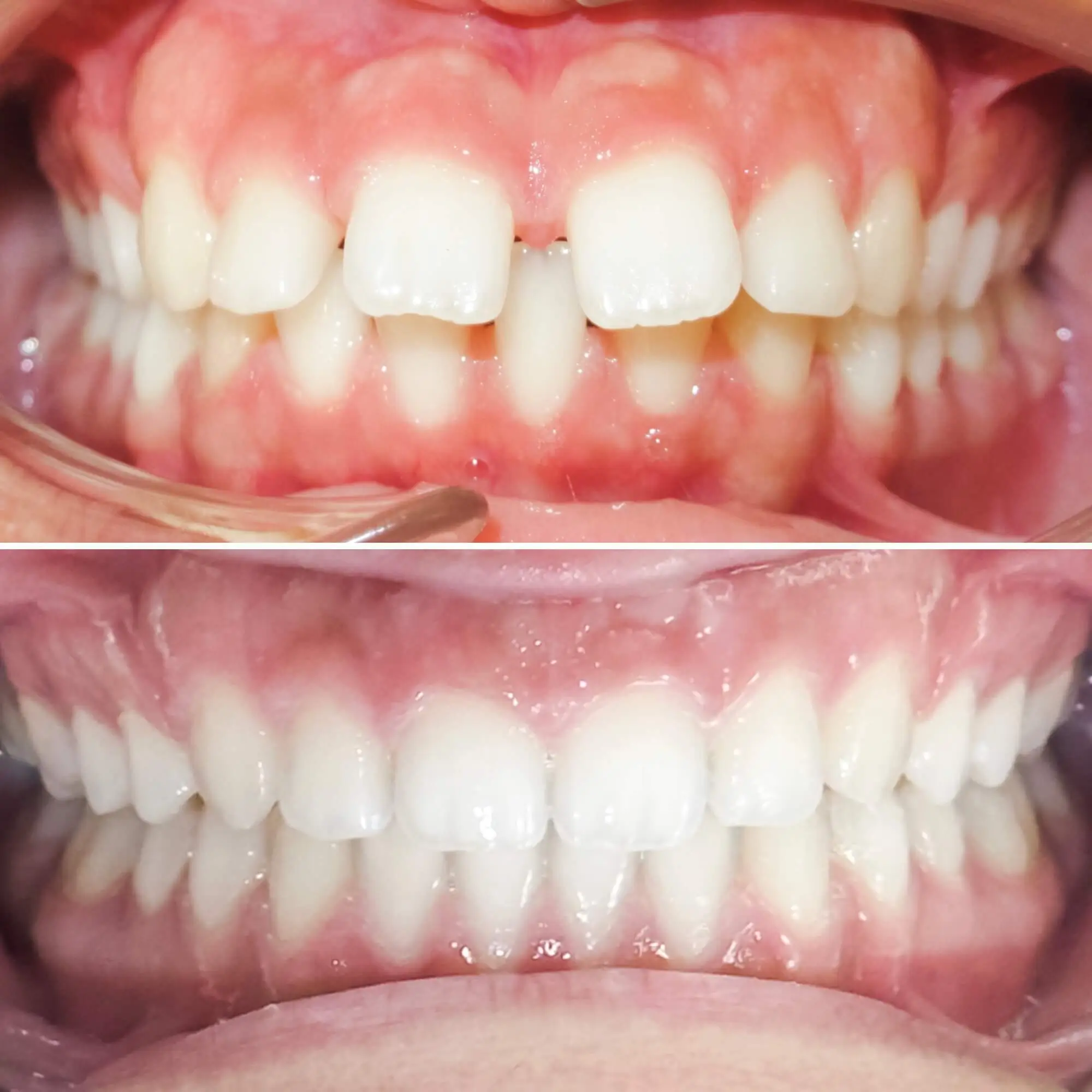Teeth spacing treated by MacKenzie Orthodontics in Saint John