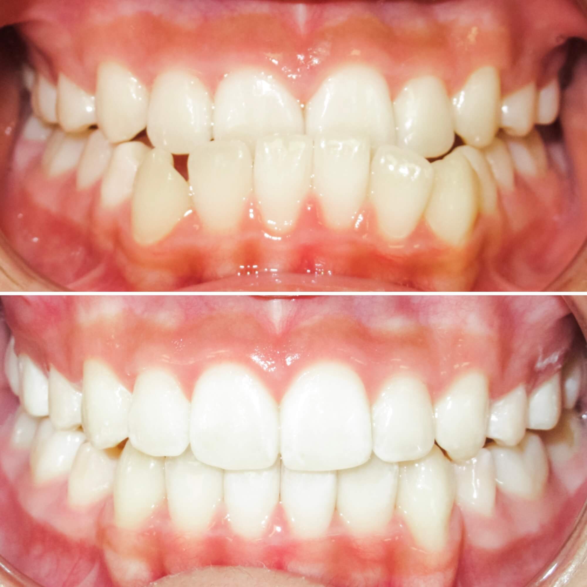Underbite treated by Dr. MacKenzie in Saint John
