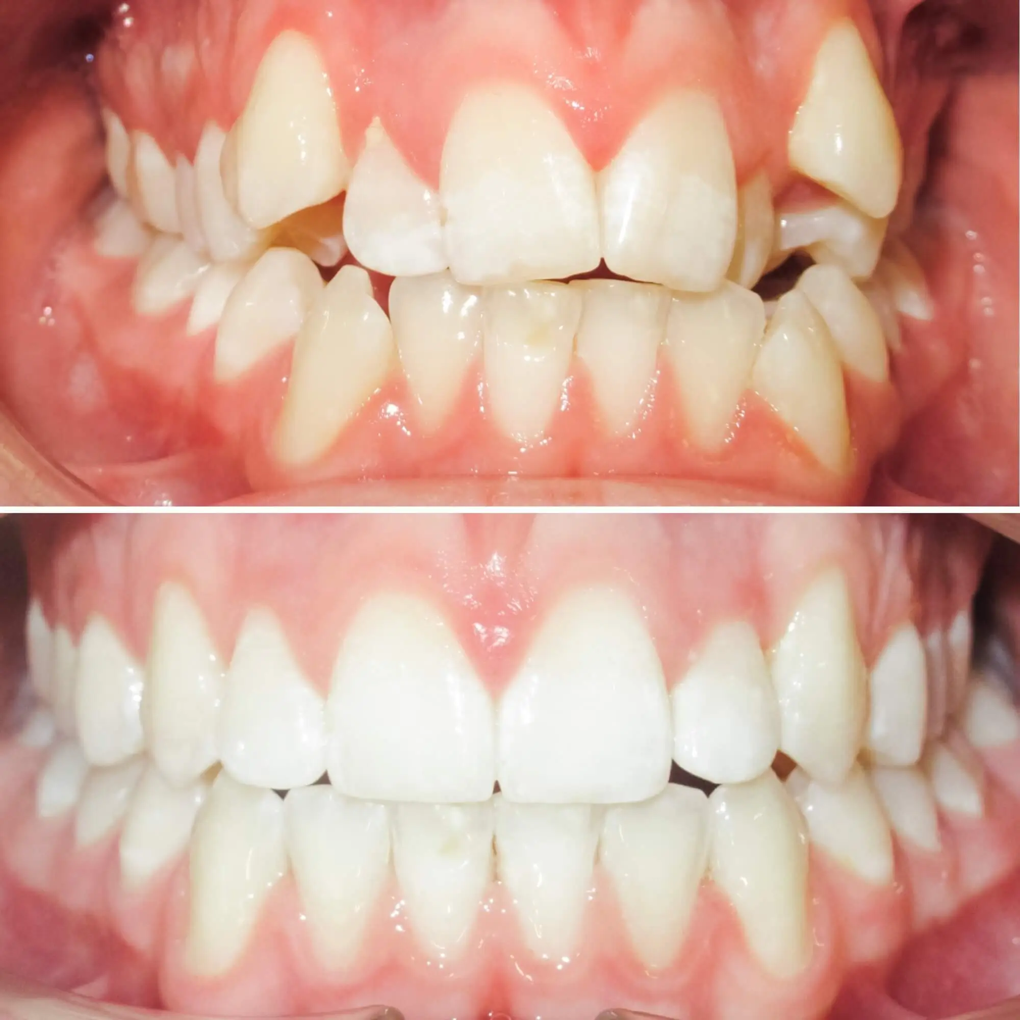 Treatment of crowding with Angel aligner before and after